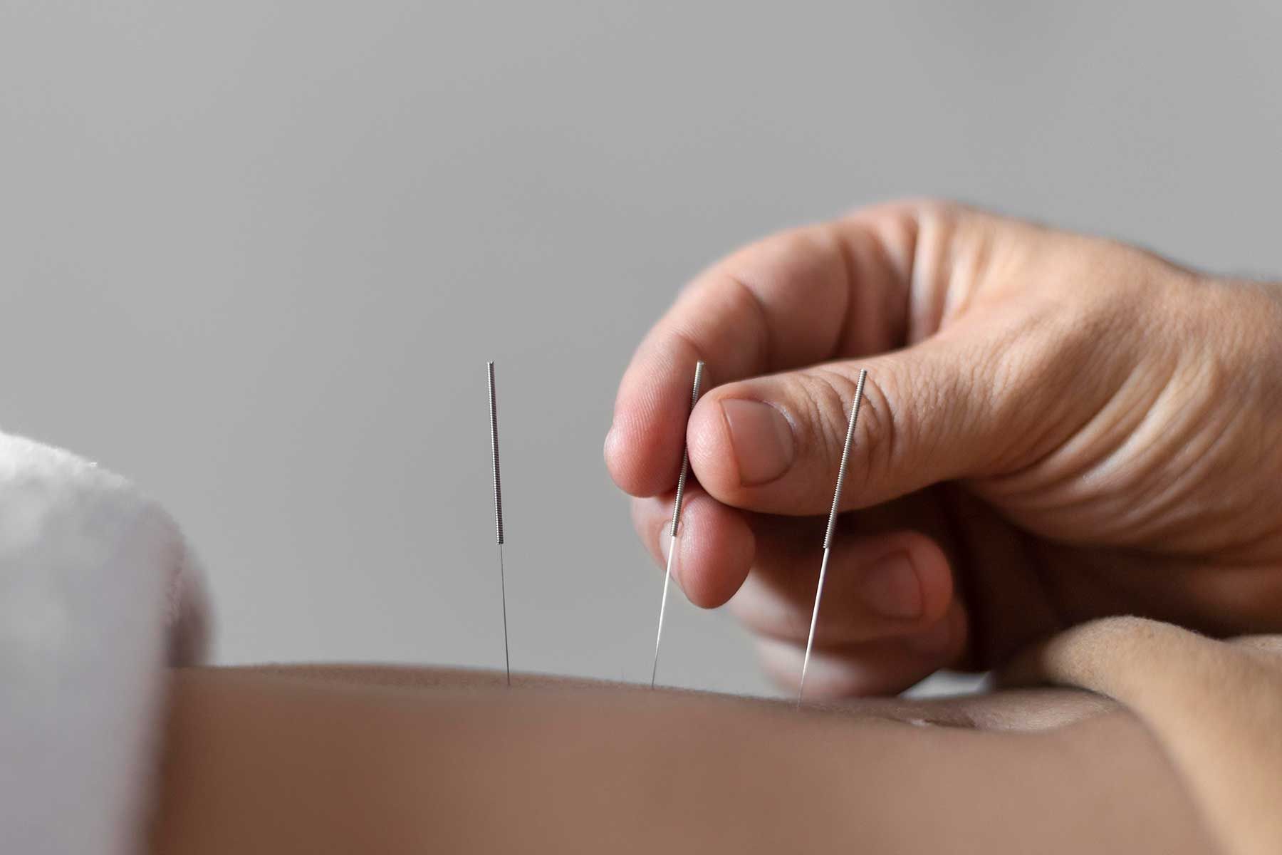 Akupunktur er en anerkjent kinesisk behandlingsmetode